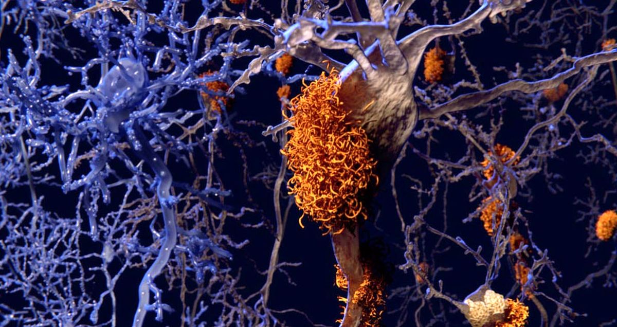 ارتباط بین متابولیسم و بی خوابی در بیماران مبتلا به آلزایمر