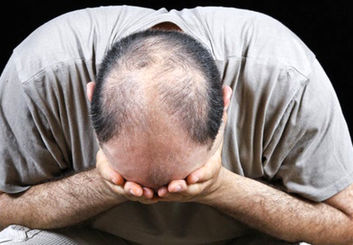 مراقب استفاده از داروی ضد ریزش موی Propecia باشید