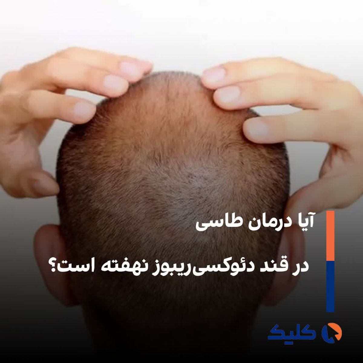 آیا درمان طاسی در قند دئوکسیریبوز نهفته است؟